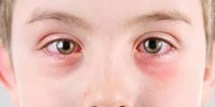 امراض العيون