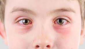 امراض العيون